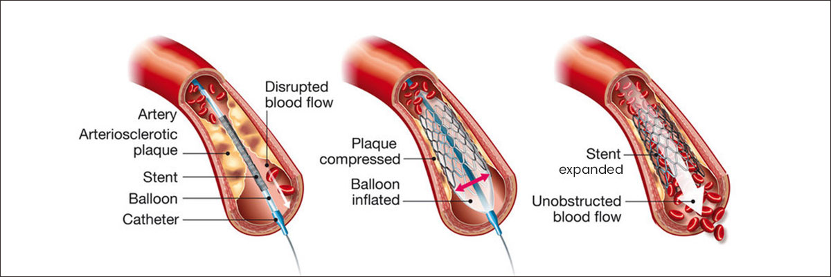 Complex Coronary Angioplasty