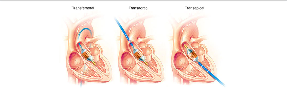 Transcatheter Aortic Valve Replacement