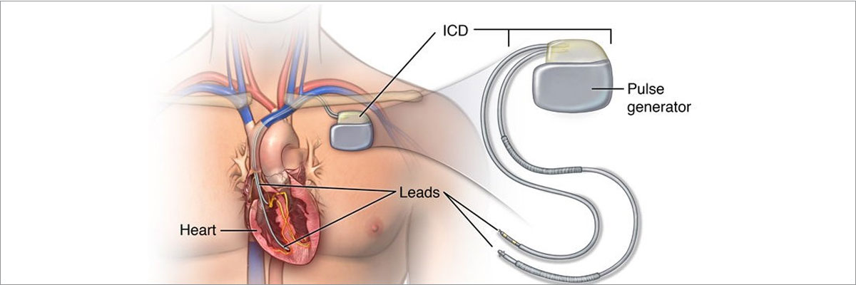 Pacemaker, CRT & ICDs Implantation