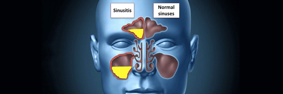 Sinus Surgery